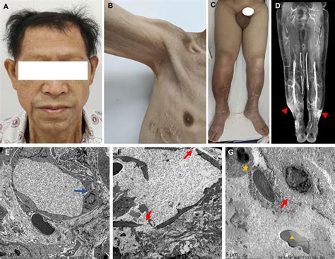 kapillarlecksyndrom symptome|Orphanet: Capillary